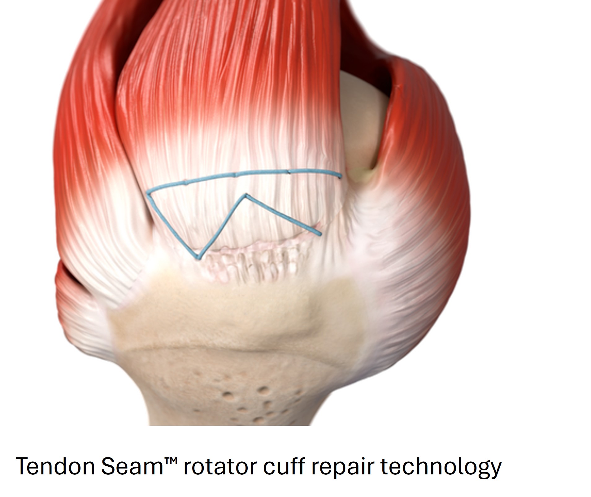 Smith+Nephew completes acquisition of Integrity Orthopaedics; establishes unrivalled portfolio for shoulder repair